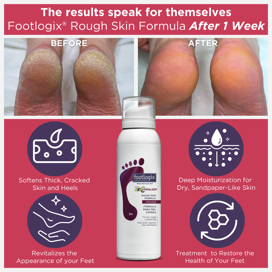 Footlogix Rough Skin Formula advertisement showing before and after effects on feet with a product bottle.