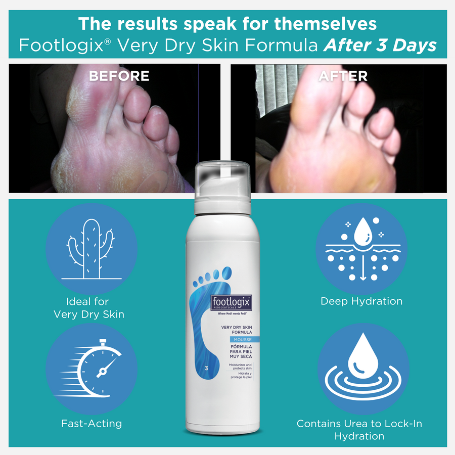 Footlogix Very Dry Skin Formula before and after images with product packaging.